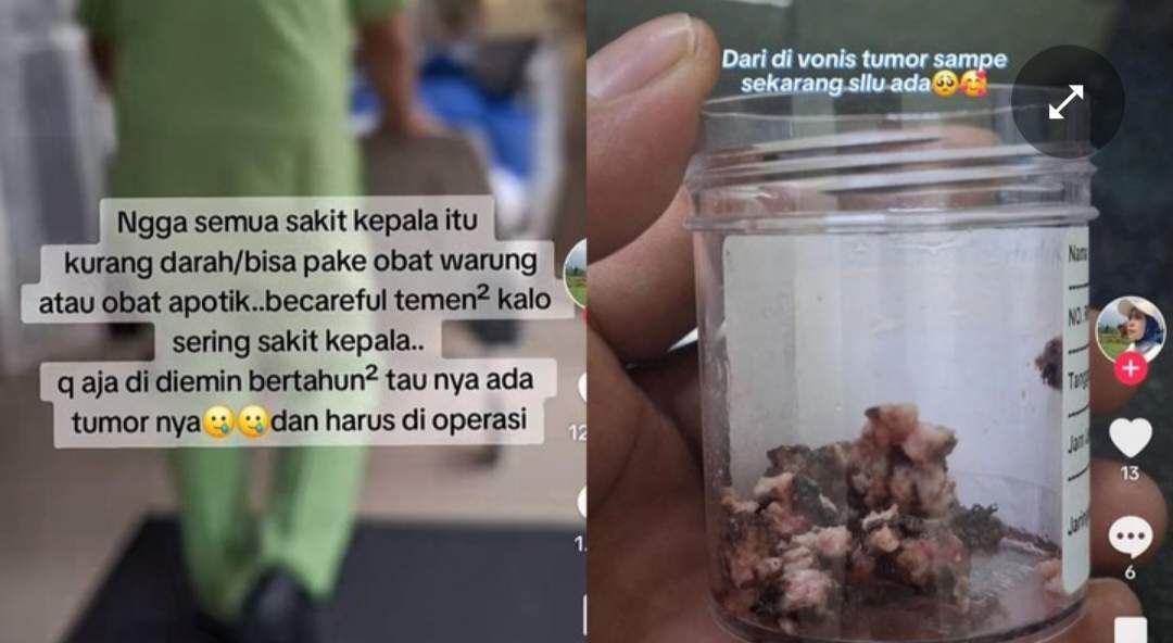 Astaghfirallah, Ngeluh Sakit Kepala 2 Tahun Ternyata Tumor Otak: Segera Periksa Jika Kamu Sering Sakit Kepala